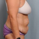 Abdominoplasty Before & After Patient #4116