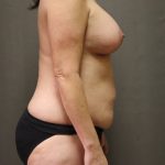 Abdominoplasty Before & After Patient #4118