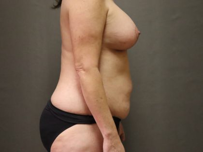 Abdominoplasty Before & After Patient #4118