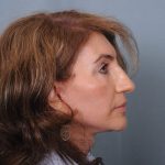 Facelift Before & After Patient #4349