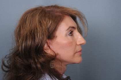 Facelift Before & After Patient #4349