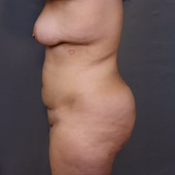 Brazilian Butt Lift Before & After Patient #4006