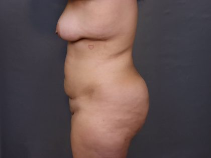 Brazilian Butt Lift Before & After Patient #4006