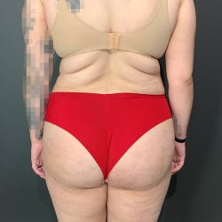 Brazilian Butt Lift Before & After Patient #4004