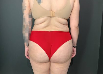 Brazilian Butt Lift Before & After Patient #4004