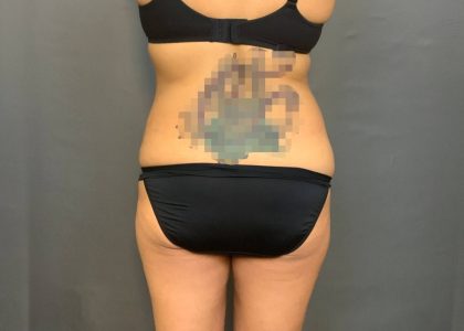 Brazilian Butt Lift Before & After Patient #4005