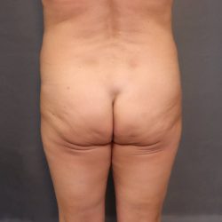 Brazilian Butt Lift Before & After Patient #4007
