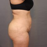 Brazilian Butt Lift Before & After Patient #4005