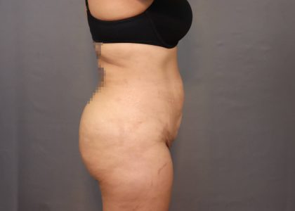 Brazilian Butt Lift Before & After Patient #4005