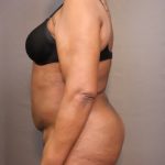 Brazilian Butt Lift Before & After Patient #4008