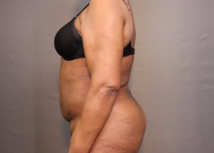 Brazilian Butt Lift Before & After Patient #4008