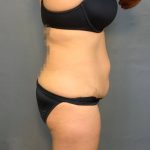 Brazilian Butt Lift Before & After Patient #4005
