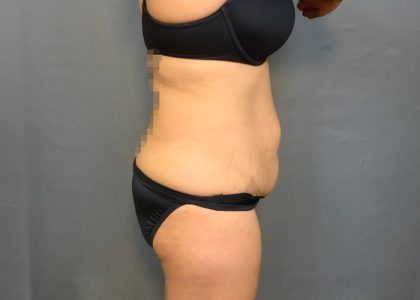 Brazilian Butt Lift Before & After Patient #4005