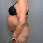 Brazilian Butt Lift Before & After Patient #4008