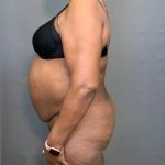 Brazilian Butt Lift Before & After Patient #4008