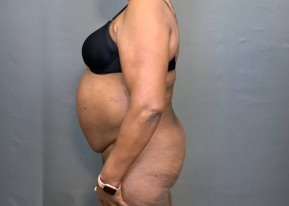 Brazilian Butt Lift Before & After Patient #4008