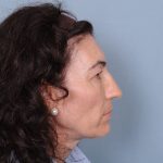 Facelift Before & After Patient #4349