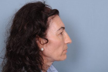 Facelift Before & After Patient #4349
