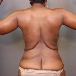 Brachioplasty Before & After Patient #3965