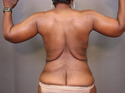 Brachioplasty Before & After Patient #3965