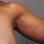 Brachioplasty Before & After Patient #3965
