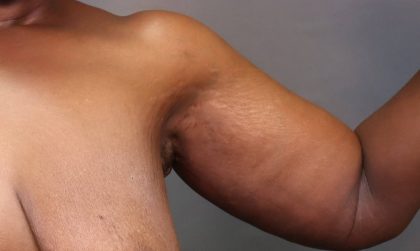 Brachioplasty Before & After Patient #3965
