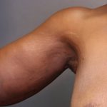 Brachioplasty Before & After Patient #3965