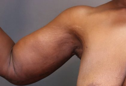 Brachioplasty Before & After Patient #3965