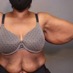Brachioplasty Before & After Patient #3965