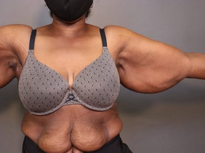 Brachioplasty Before & After Patient #3965