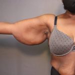 Brachioplasty Before & After Patient #3965