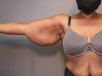 Brachioplasty Before & After Patient #3965