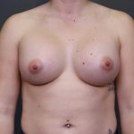 Breast Augmentation Before & After Patient #3919