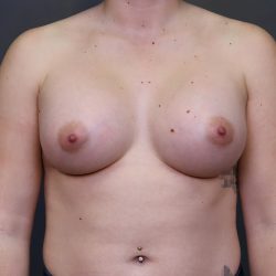 Breast Augmentation Before & After Patient #3919