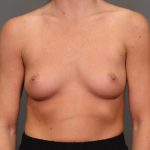 Breast Augmentation Before & After Patient #3926