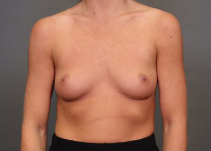 Breast Augmentation Before & After Patient #3926