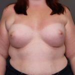 Breast Augmentation Before & After Patient #3935