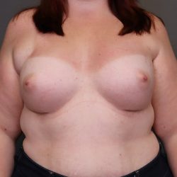 Breast Augmentation Before & After Patient #3935