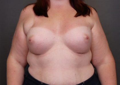 Breast Augmentation Before & After Patient #3935