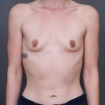 Breast Augmentation Before & After Patient #3910