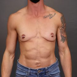 Breast Augmentation Before & After Patient #3912