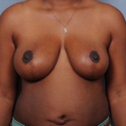 Breast Reduction Before & After Patient #4128