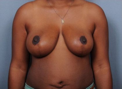 Breast Reduction Before & After Patient #4128
