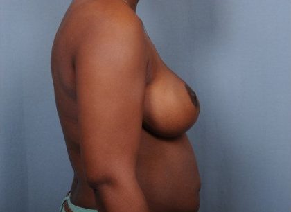 Breast Reduction Before & After Patient #4128