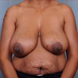 Breast Reduction Before & After Patient #4129