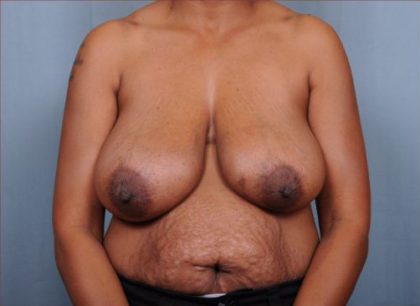 Breast Reduction Before & After Patient #4129
