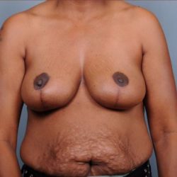 Breast Reduction Before & After Patient #4129