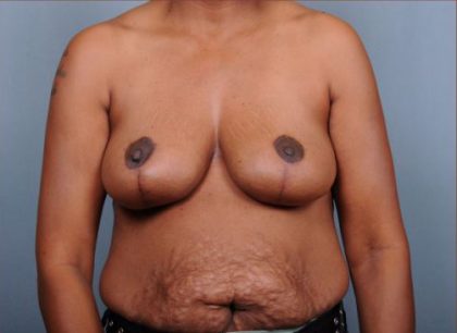 Breast Reduction Before & After Patient #4129