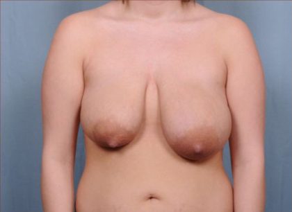 Breast Reduction Before & After Patient #4132