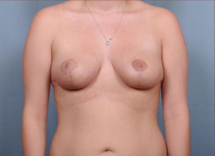 Breast Reduction Before & After Patient #4132